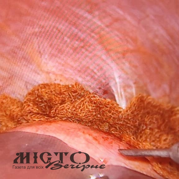 Лікарі Володимирського ТМО видалили великого гельмінта у 50-річної жінки 