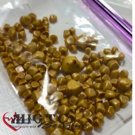 Хірурги Володимирського ТМО видалили пацієнтці жовчний міхур разом із понад сотнею камінців 