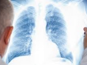 У березні в Україні у 957 людей вперше виявили туберкульоз 