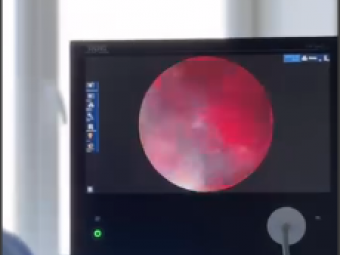 У Нововолинській лікарні з’явилося сучасне обладнання для малоінвазивних ЛОР-операцій 