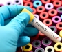 У Володимирському ТМО збільшилася кількість пацієнтів з вірусним гепатитом В 